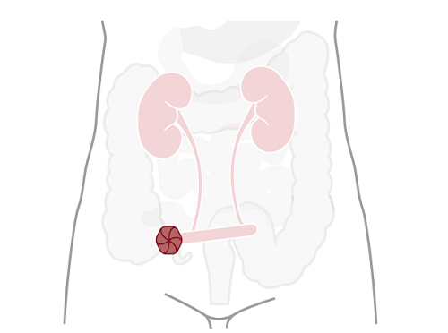 urostomie ledviny močová soustava