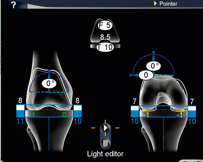 OrthoPilot® - navigační systém u operací kloubů