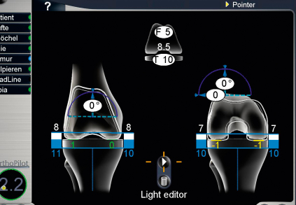 OrthoPilot® - navigační systém u operací kloubů