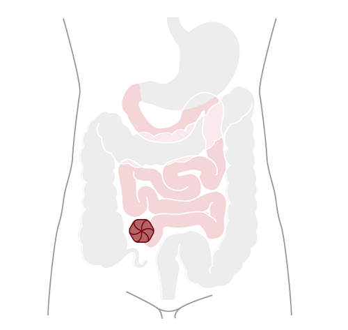 Ileostomie je vývod tenkého střeva 